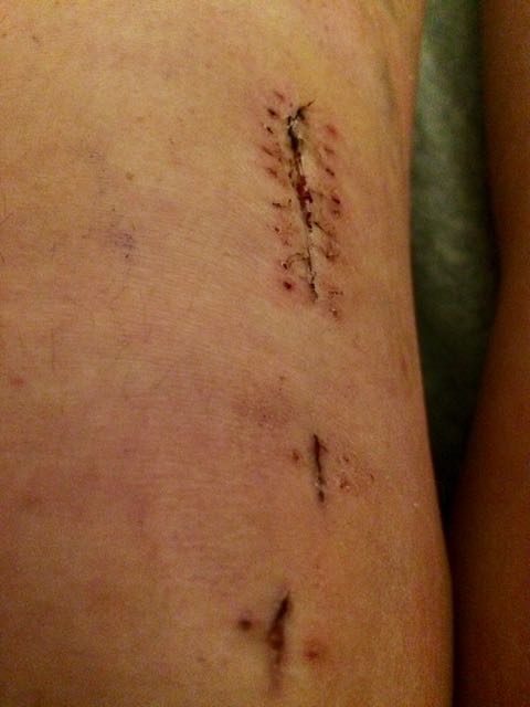 How do I deep clean my big stupid leg brace? : r/ACL