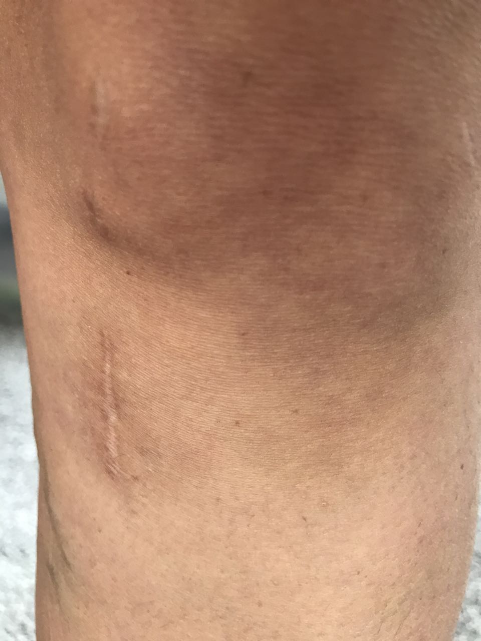 7 - My ACL Journey - Sleeping, Showering, and Riding in a Car